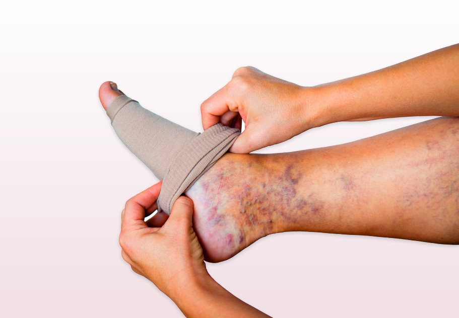 How To Choose And Use Compression Stockings